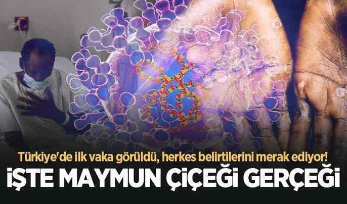 Türkiye’de de görülen Maymun Çiçeği virüsüyle ilgili bilgiler!